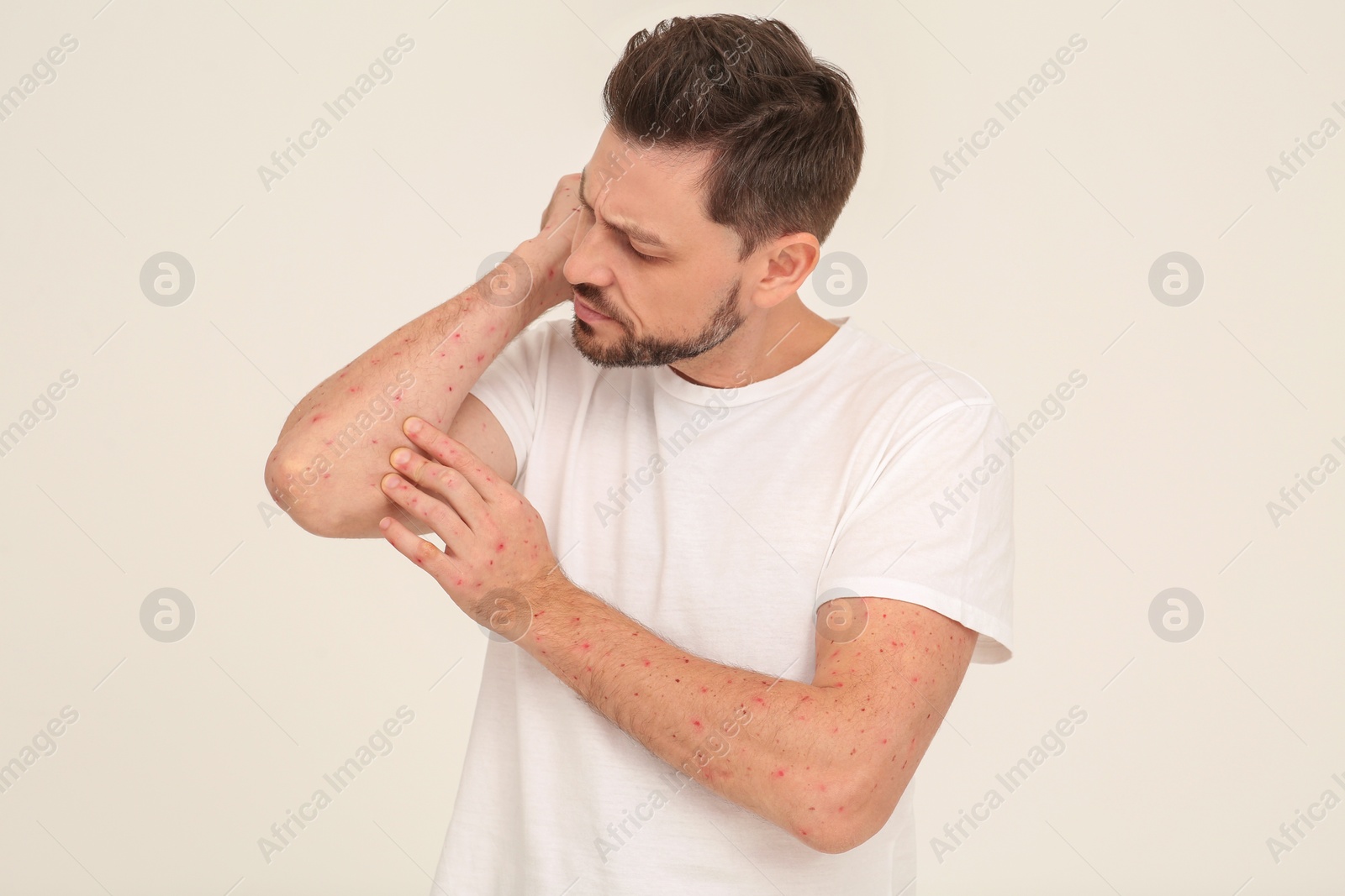 Photo of Man with rash suffering from monkeypox virus on beige background