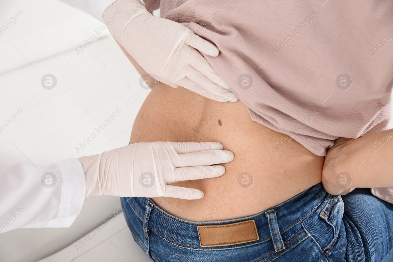 Photo of Dermatologist examining mature patient's birthmark in clinic, closeup