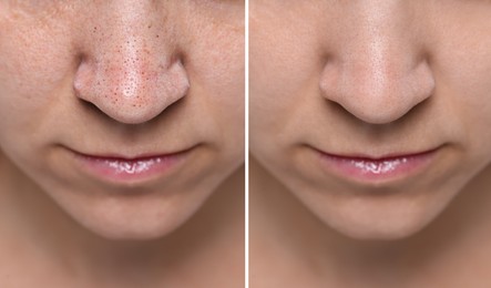 Image of Blackhead treatment, before and after. Collage with photos of woman, closeup view