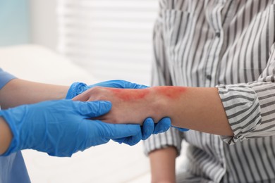 Doctor examining patient's burned hand indoors, closeup