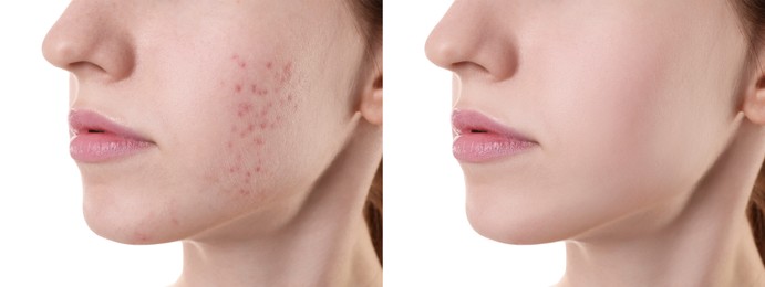 Acne problem. Young woman before and after treatment on white background, closeup. Collage of photos