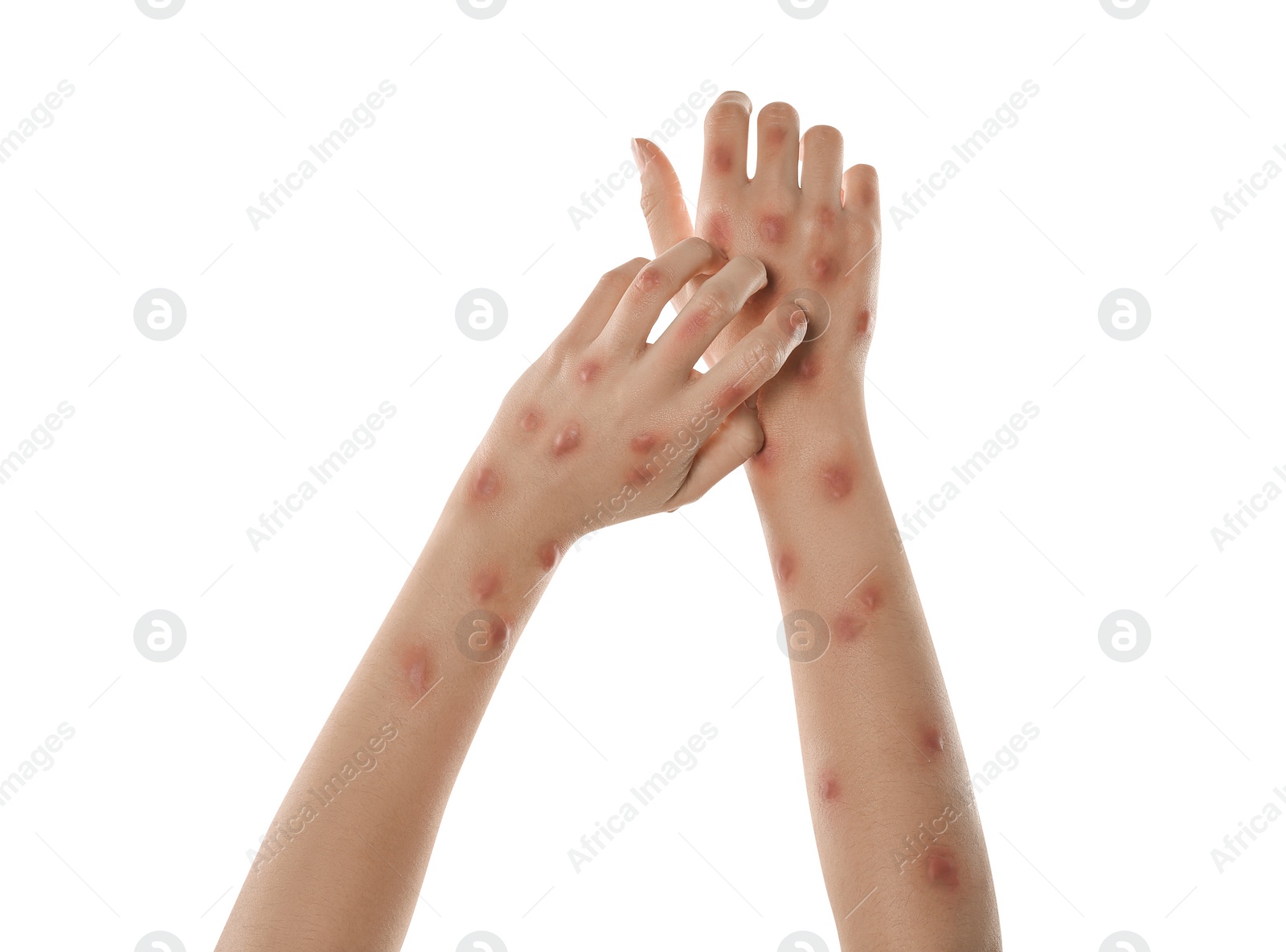 Photo of Woman with rash suffering from monkeypox virus on white background, closeup