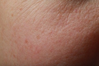 Photo of Closeup view of human skin as background