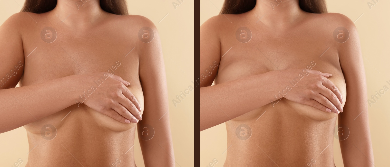 Image of Collage with photos of woman before and after breast-lift surgery on beige background, closeup