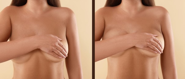 Collage with photos of woman before and after breast-lift surgery on beige background, closeup