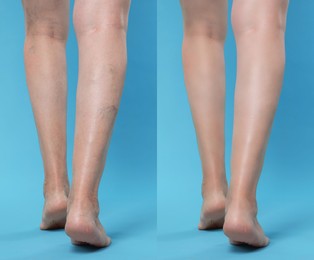 Image of Before and after varicose veins treatment. Collage with photos of woman showing legs on light blue background, closeup