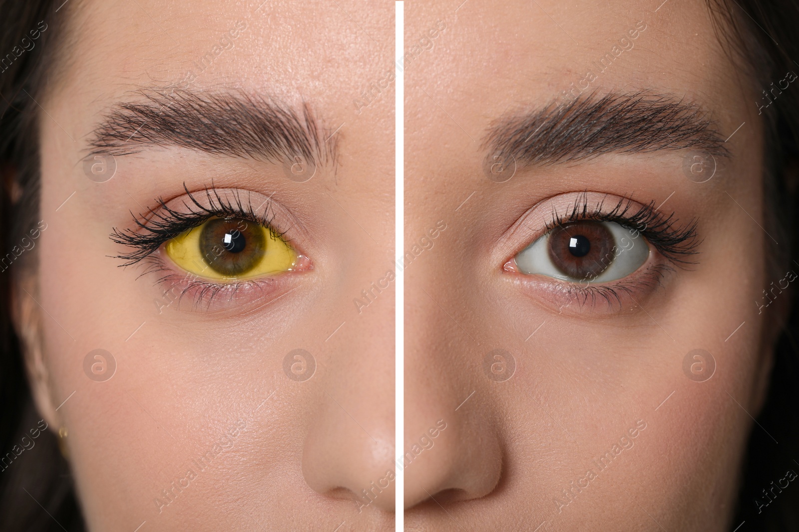 Image of Collage with photos of woman before and after hepatitis treatment, focus on eyes