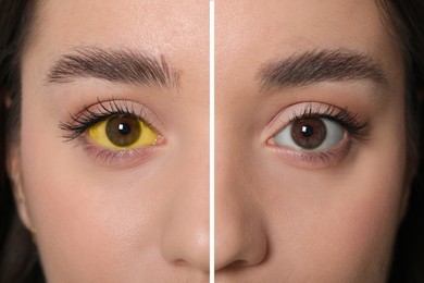 Collage with photos of woman before and after hepatitis treatment, focus on eyes
