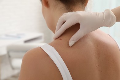 Dermatologist examining patient's birthmark in clinic, closeup