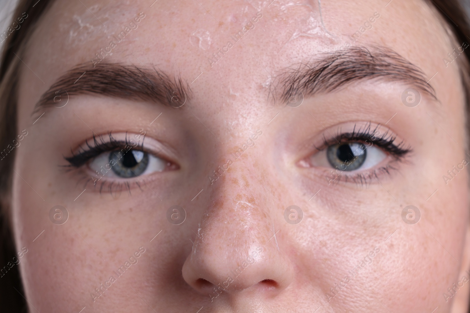 Photo of Woman with dry skin on face, macro view