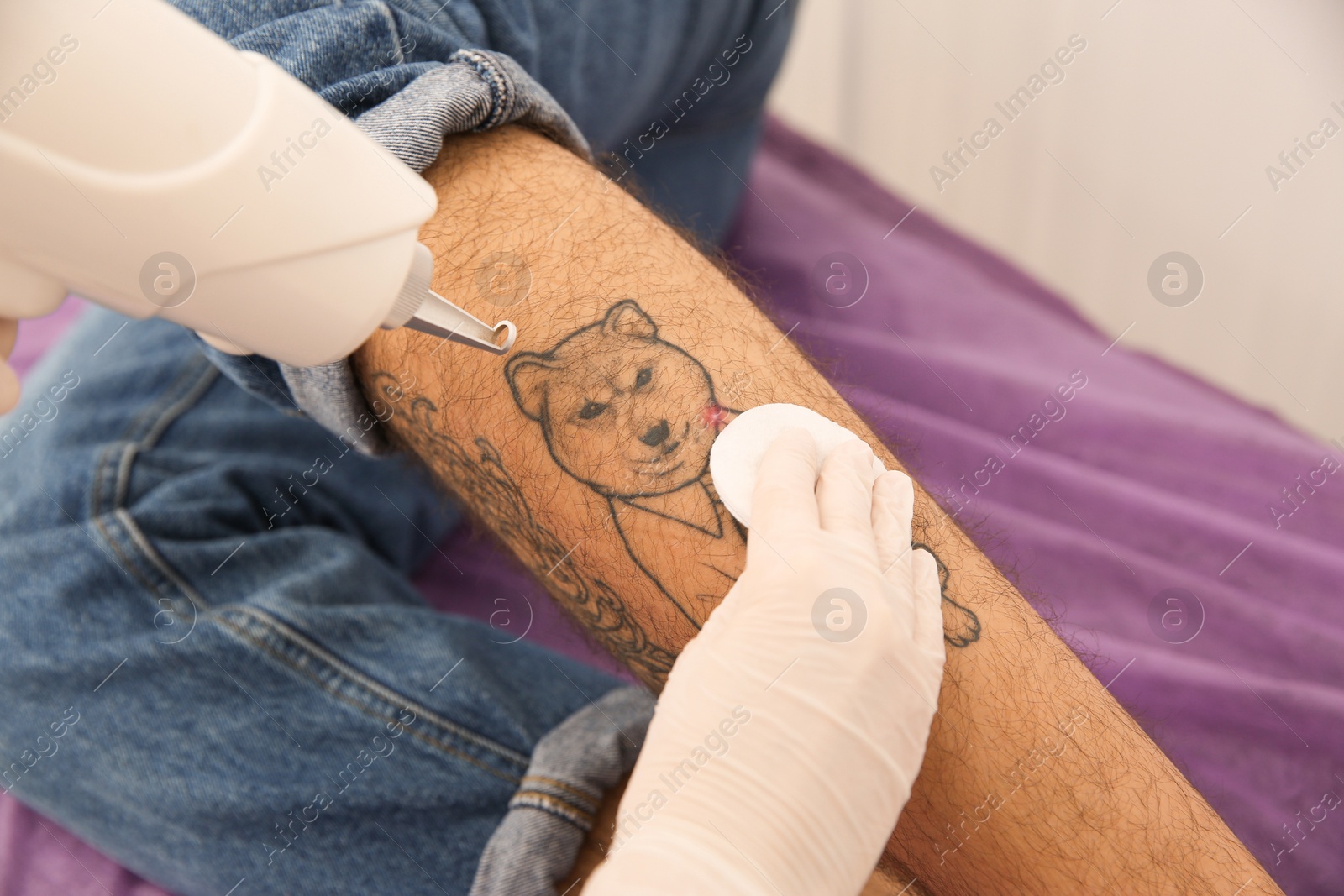 Photo of Young man undergoing laser tattoo removal procedure in salon, closeup