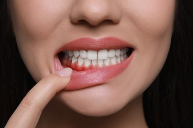 Image of Woman showing inflamed gum, closeup. Oral cavity health