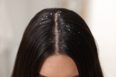 Woman with dandruff in her dark hair on blurred background, closeup