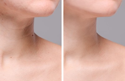 Image of Aging skin changes. Woman showing neck before and after rejuvenation, closeup. Collage comparing skin condition