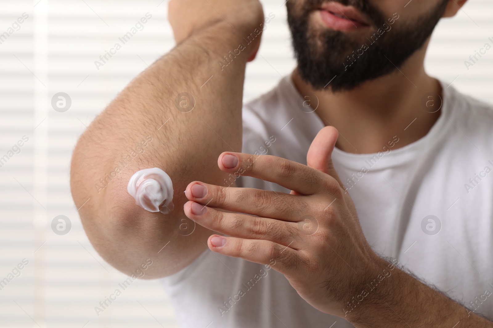 Photo of Man with dry skin applying cream onto his elbow on light background, closeup