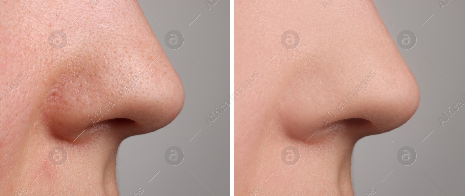 Image of Before and after acne treatment. Photos of woman on grey background, closeup. Collage showing affected and healthy skin