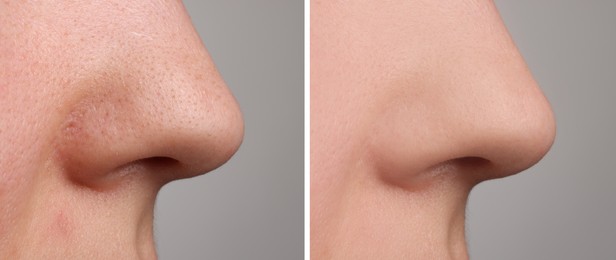 Image of Before and after acne treatment. Photos of woman on grey background, closeup. Collage showing affected and healthy skin