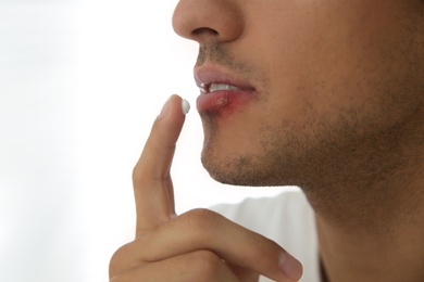 Man with herpes applying cream on lips against light background, closeup