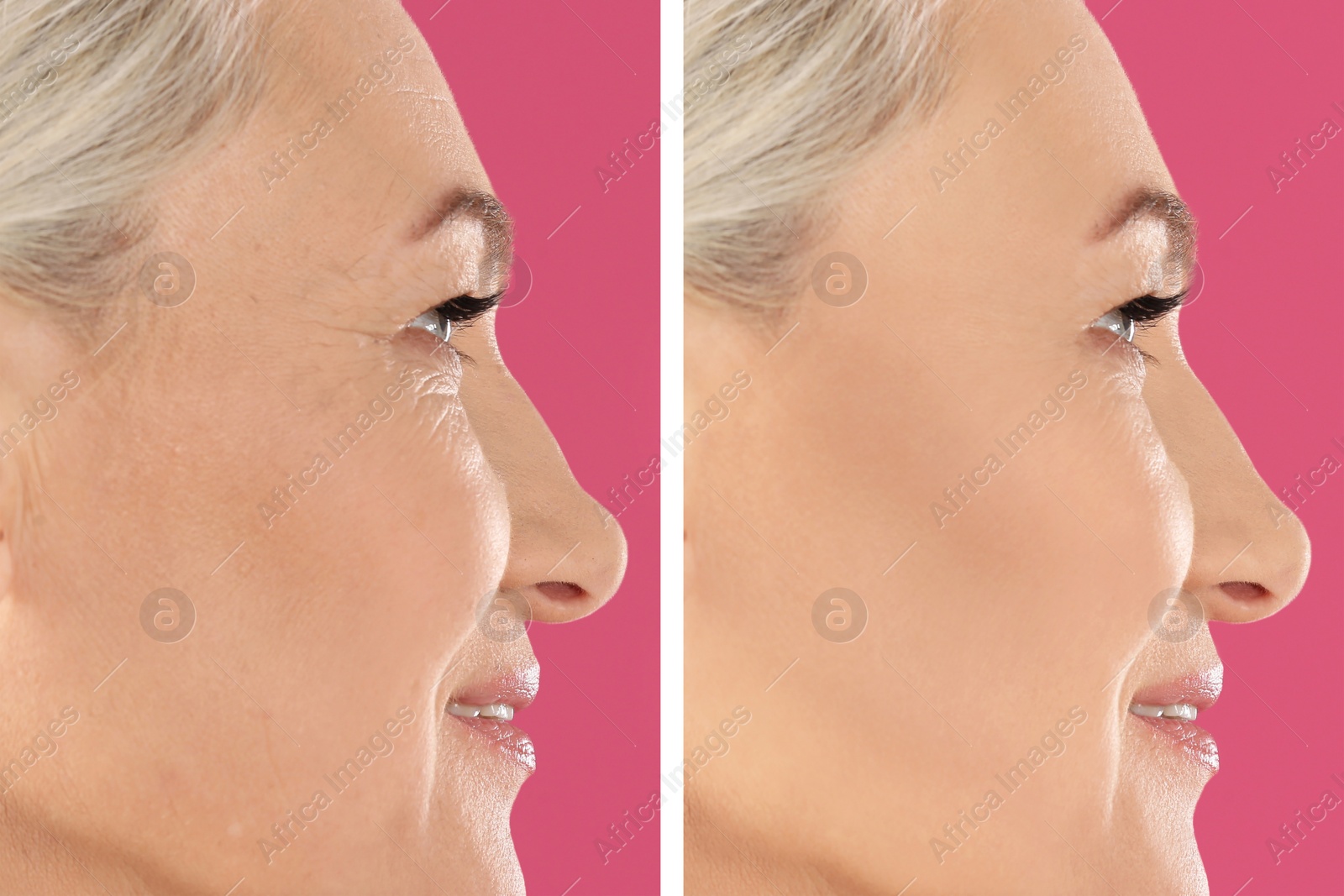 Image of Collage with photos of mature woman before and after biorevitalization procedure on pink background, closeup 