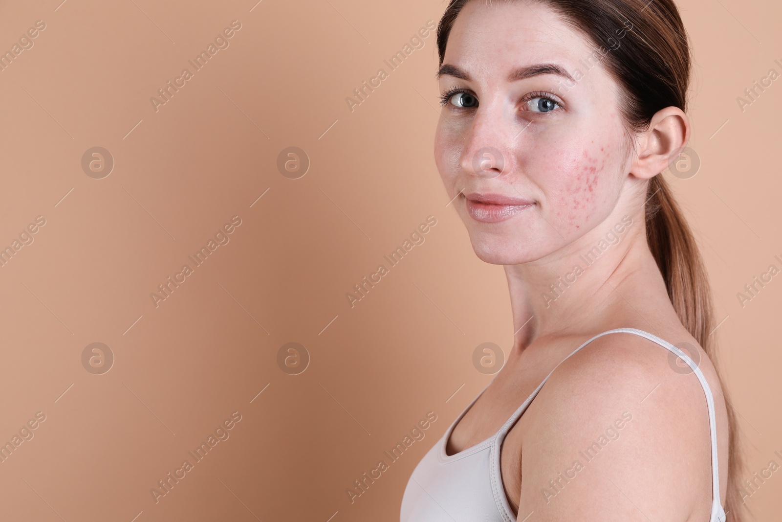 Photo of Young woman with acne problem on beige background. Space for text