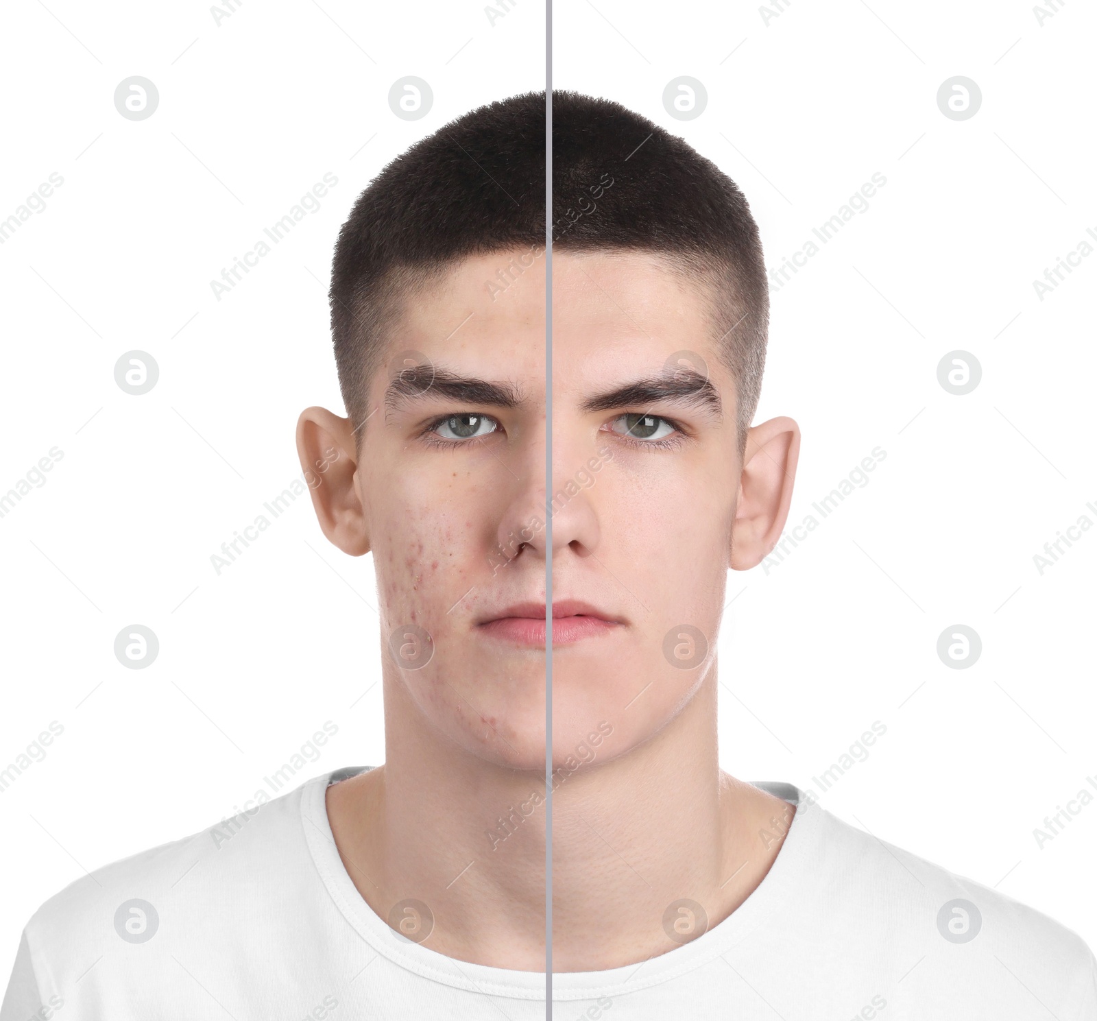 Image of Acne problem, collage. Photo of man divided into halves before and after treatment on white background