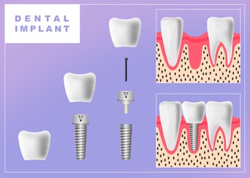 Image of Structure of dental implant on light violet background, illustration. Educational poster