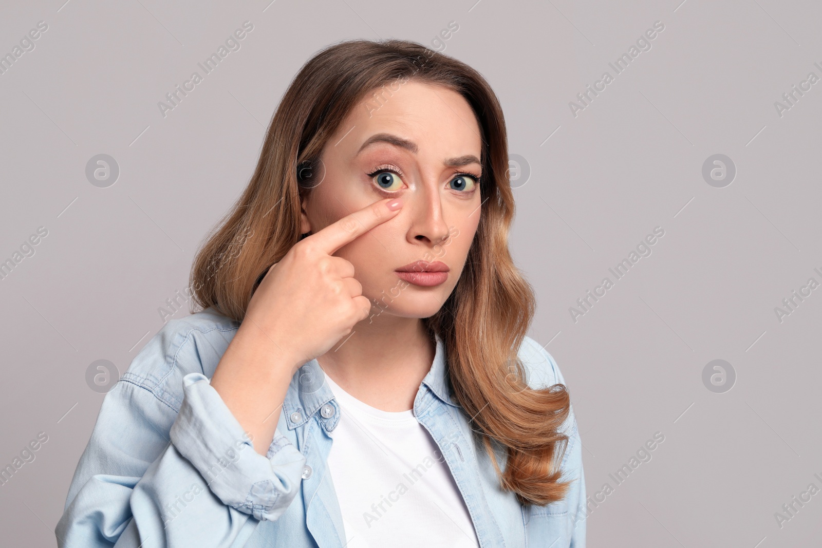 Photo of Woman with yellow eyes on grey background. Liver problems symptom