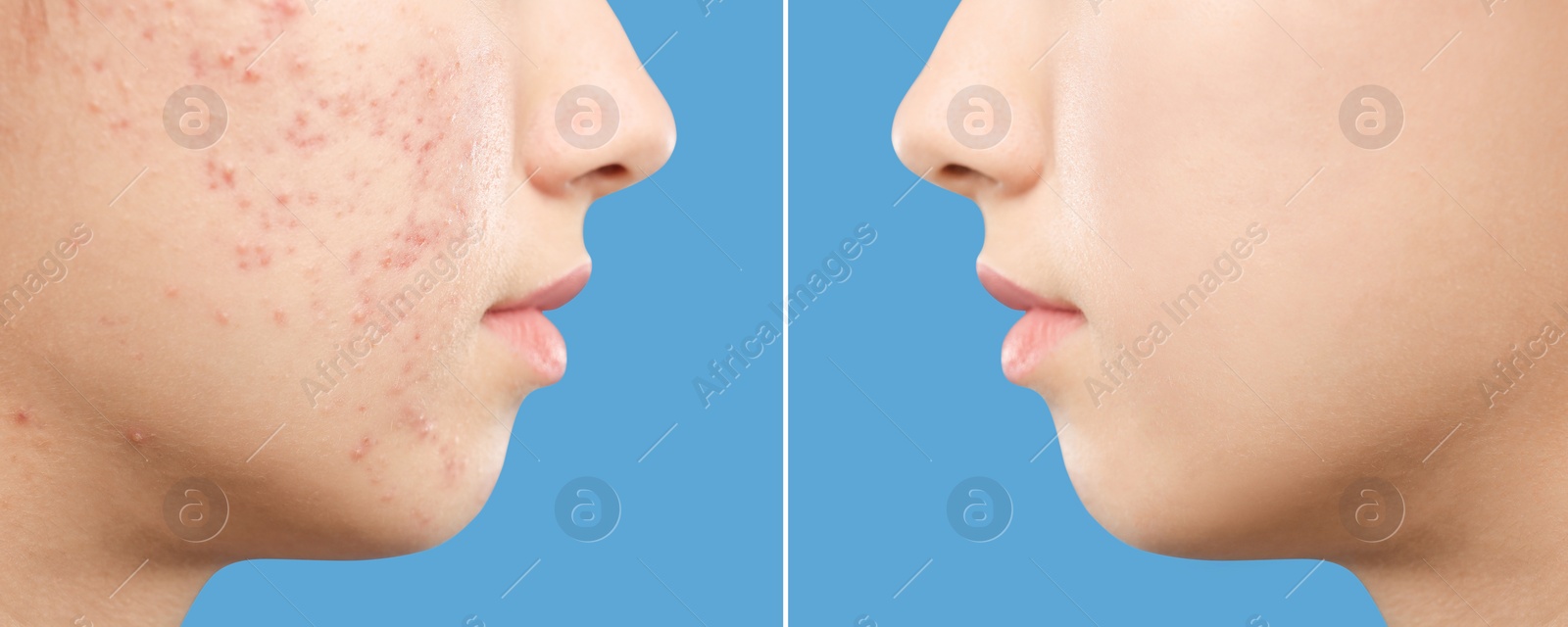 Image of Teenage girl before and after acne treatment on blue background, closeup