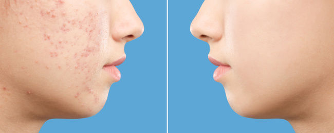 Image of Teenage girl before and after acne treatment on blue background, closeup