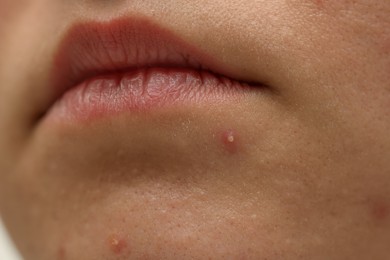 Photo of Young woman with acne on her face, closeup