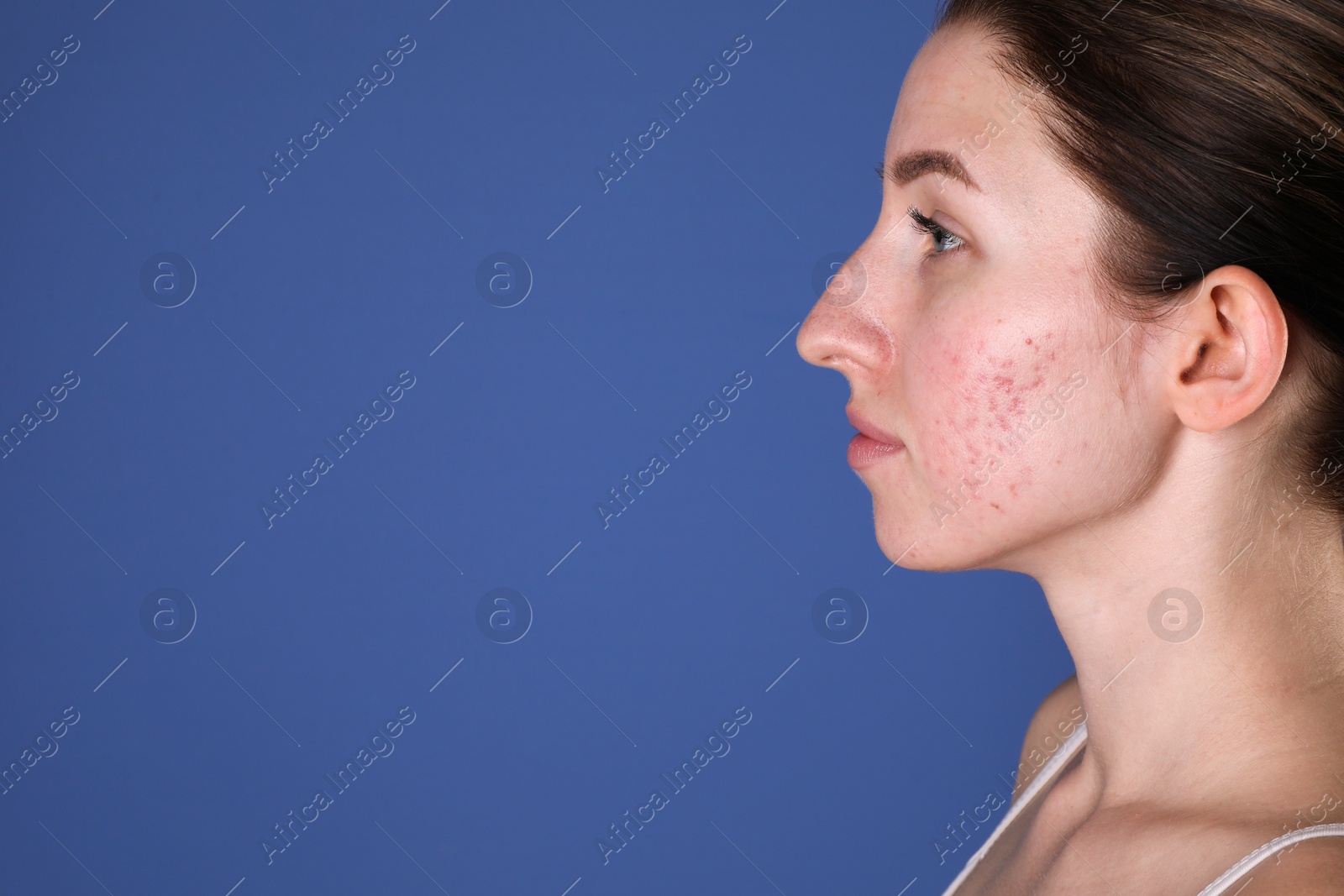 Photo of Young woman with acne problem on blue background. Space for text