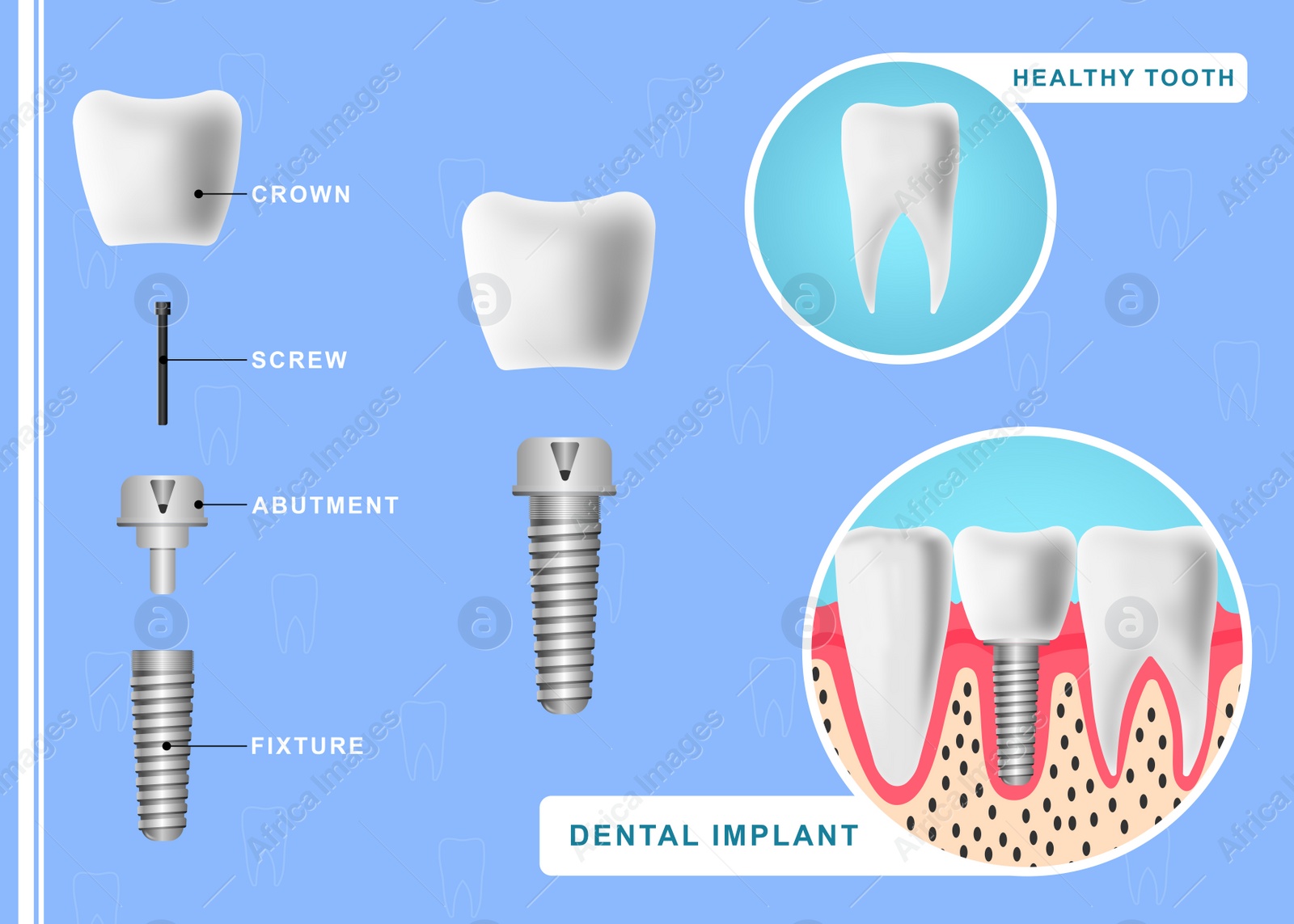 Image of Structure of dental implant on light blue background, illustration. Educational poster