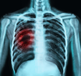 Illustration of  X-ray of patient with lung cancer. Illustration