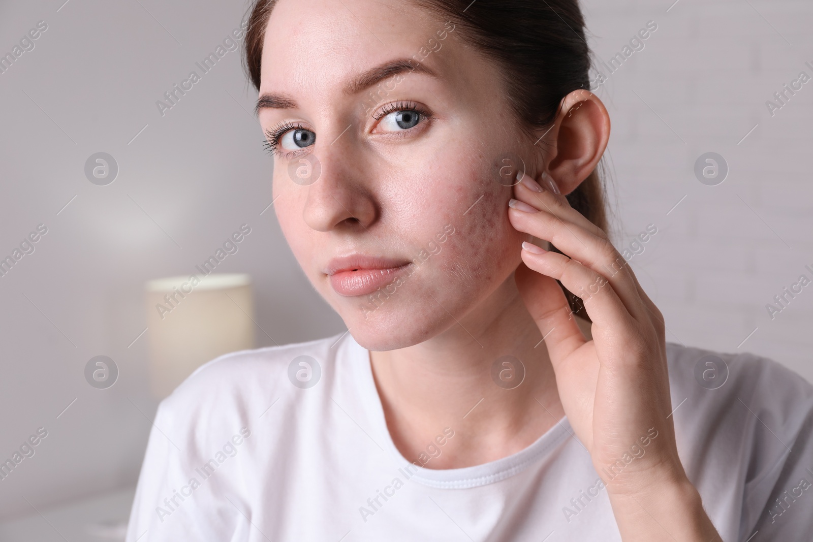 Photo of Young woman with acne problem at home