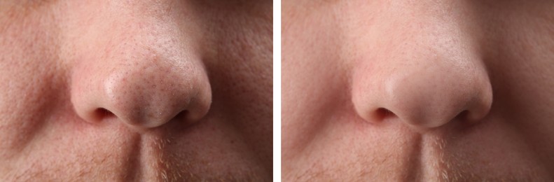 Photos of man before and after acne treatment, closeup. Collage showing affected and healthy skin