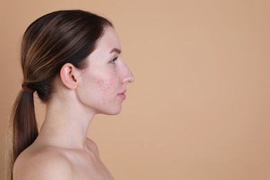 Photo of Young woman with acne problem on beige background. Space for text