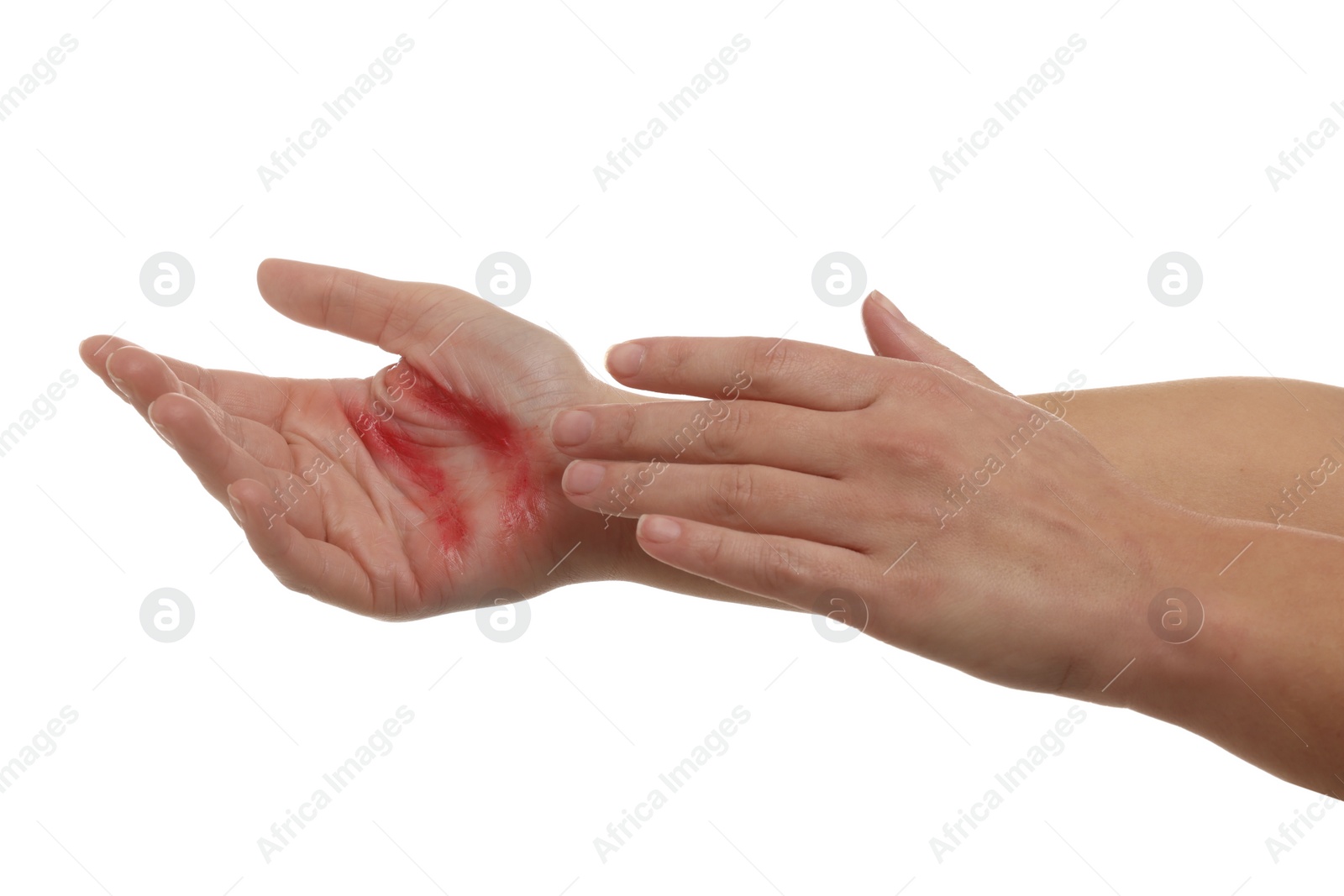 Photo of Woman with burned hand on white background, closeup