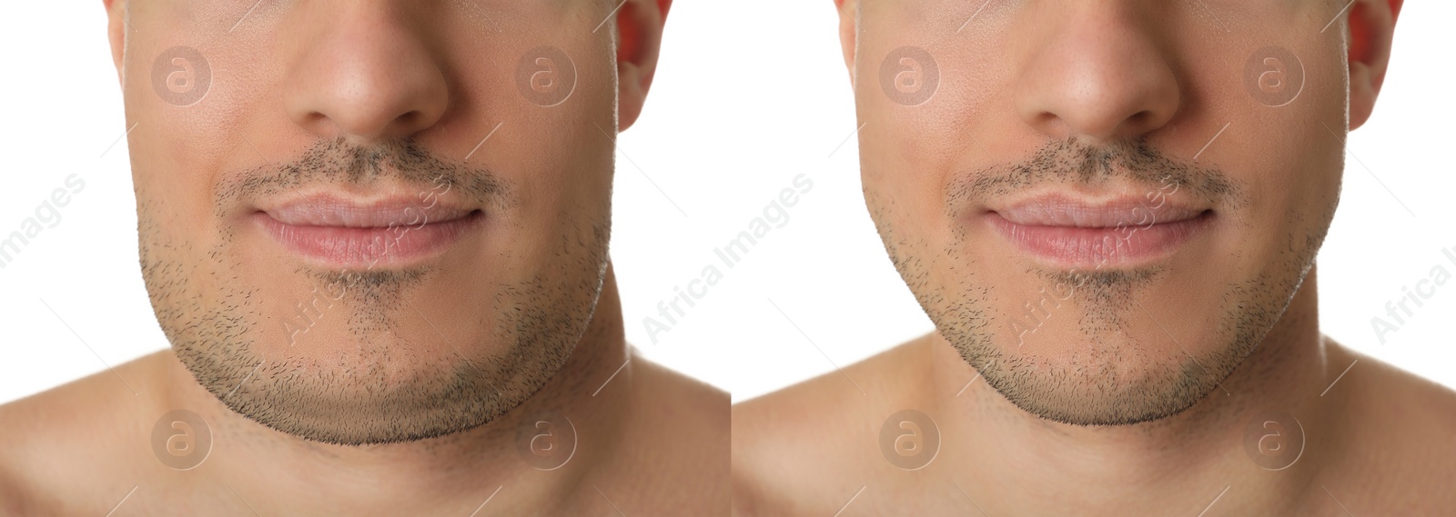 Image of Double chin problem. Collage with photos of man before and after plastic surgery procedure on white background, closeup. Banner design