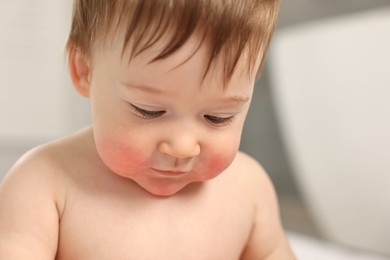 Photo of Cute little baby with allergic redness on cheeks indoors, closeup