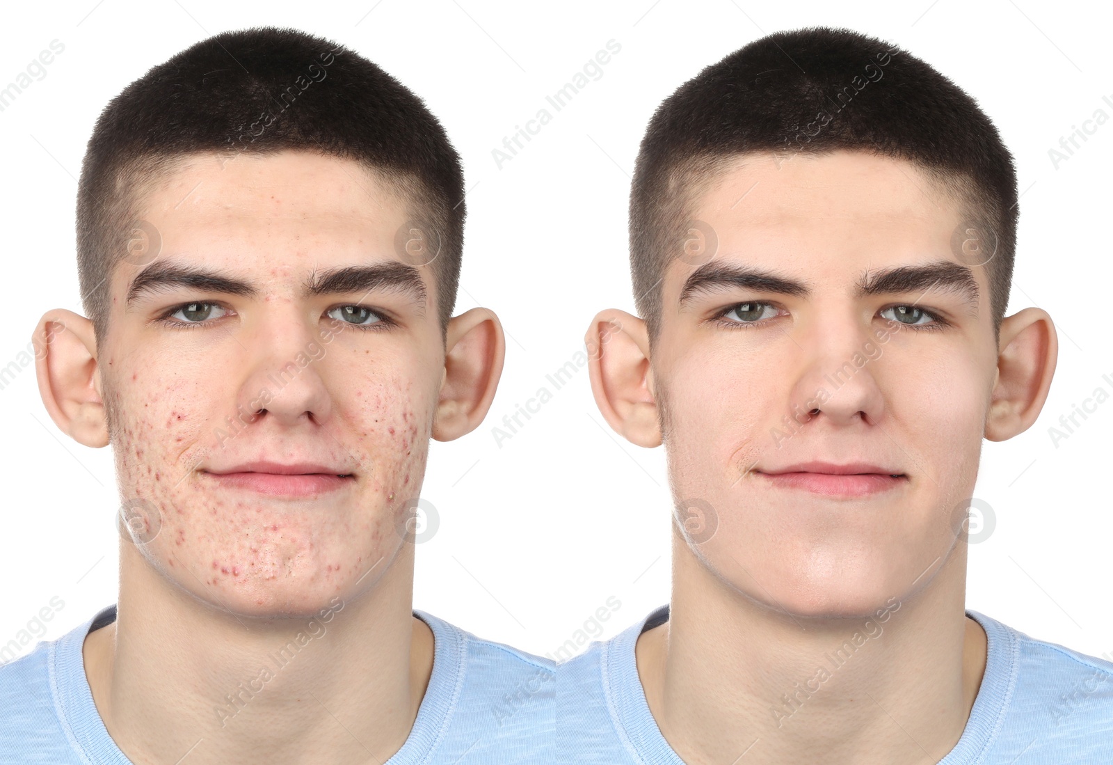 Image of Acne problem. Young man before and after treatment on white background, collage of photos