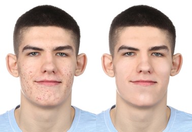 Acne problem. Young man before and after treatment on white background, collage of photos