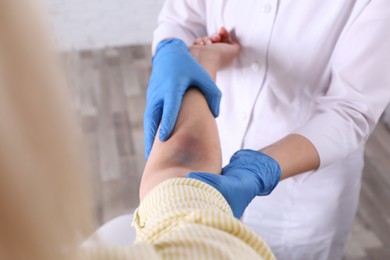 Photo of Doctor checking woman's elbow with bruise at hospital, closeup