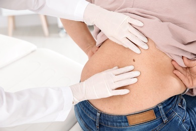 Dermatologist examining mature patient's birthmark in clinic, closeup