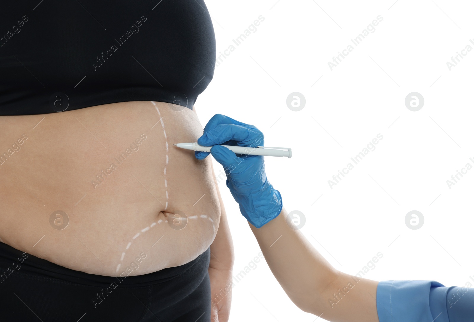 Photo of Doctor drawing marks on obese woman's body against white background, closeup. Weight loss surgery