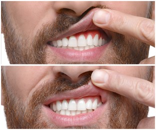 Man showing gum before and after treatment, collage of photos