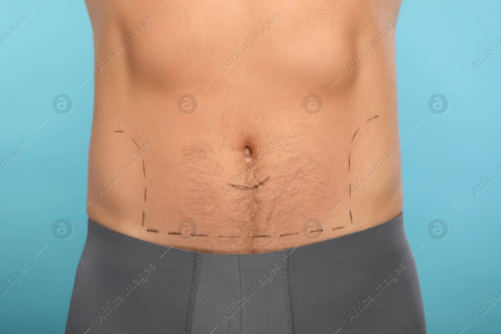 Photo of Man with markings on belly before cosmetic surgery operation on light blue background, closeup