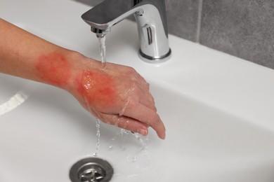 Photo of Woman holding burned hand under cold water indoors, closeup