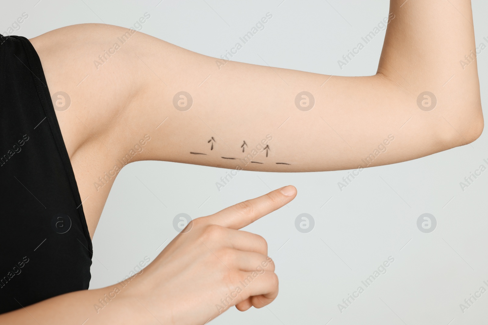 Photo of Slim woman with marks on arm against light background, closeup. Weight loss surgery