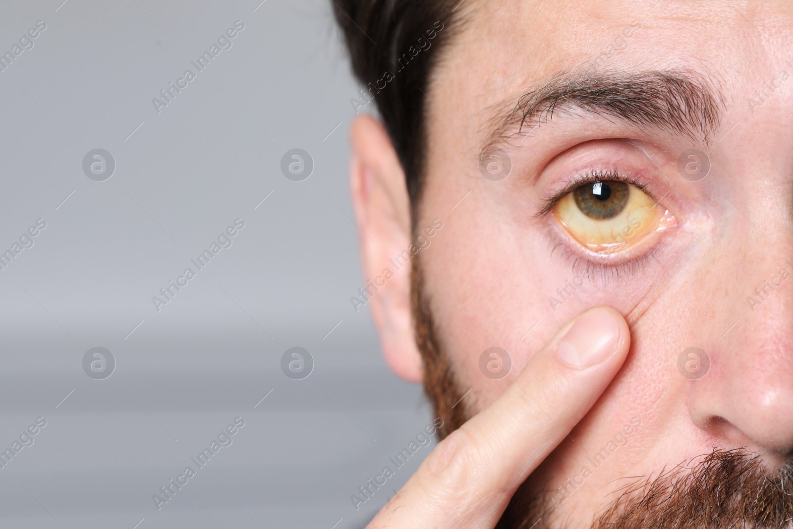 Photo of Man with yellow eyes on blurred background, closeup. Symptom of hepatitis