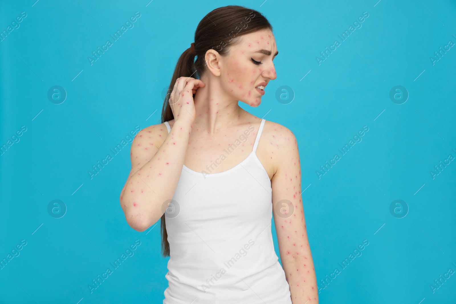 Photo of Woman with rash suffering from monkeypox virus on light blue background